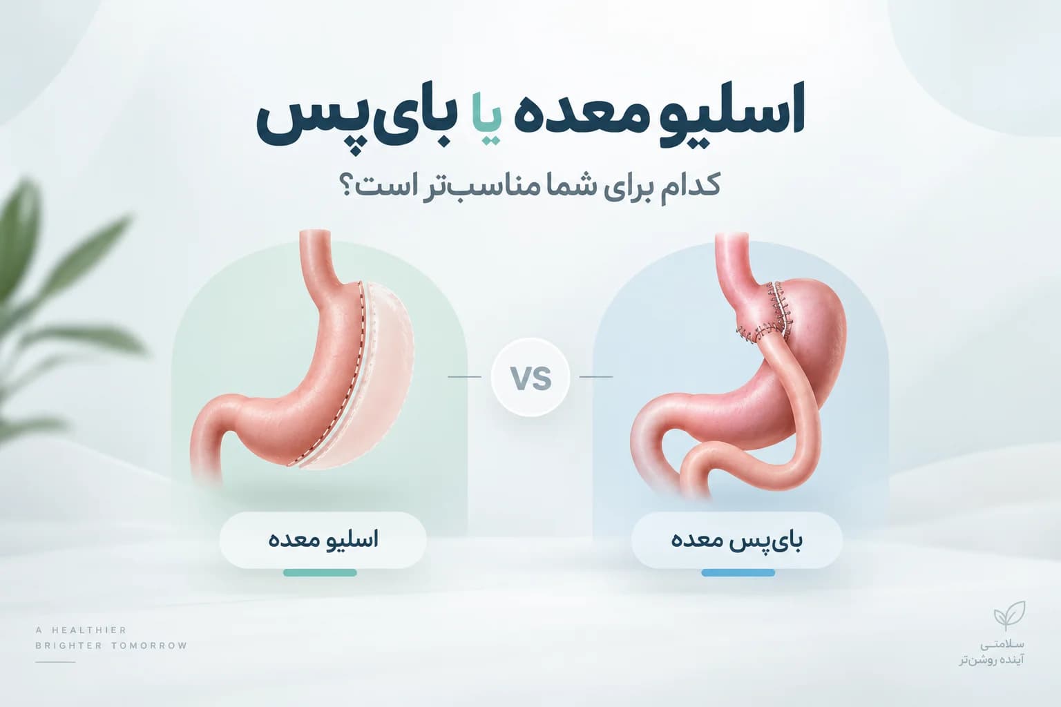 اسلیو معده یا بای پس