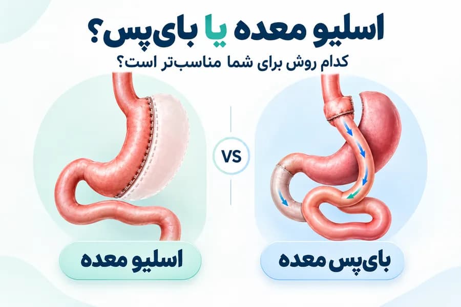 اسلیو معده یا بای پس
