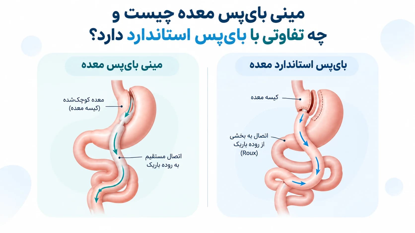 مینی بای پس در مقابل بای پس استاندارد